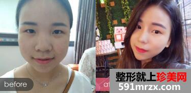 隆鼻前后对比图，整形价格表曝光