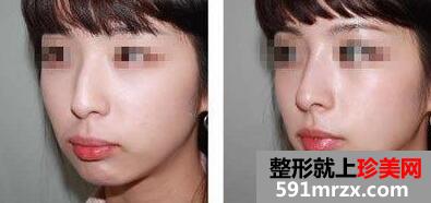 鹰钩鼻整形前后对比图