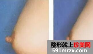 乳头乳晕缩小前后对比图