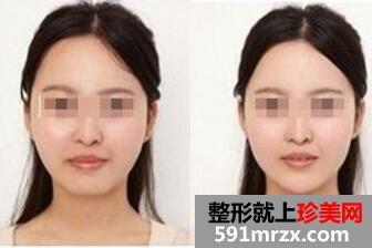 垫下巴前后对比图，垫下巴多少钱？