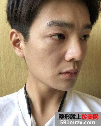 北京超声刀面部紧致对比图和真实案例 超声刀价格