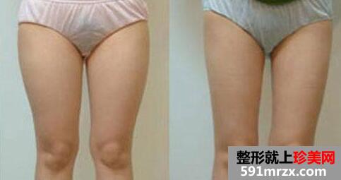 吸脂减肥瘦大腿前后对比图