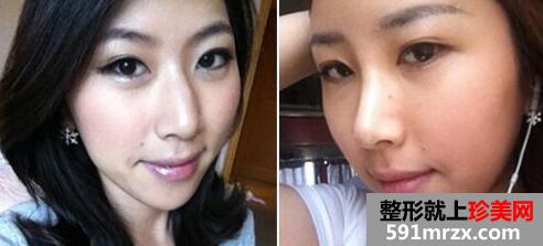 驼峰鼻矫正前后对比图，上海正规医院做驼峰鼻矫正多少钱？最好的医院推荐
