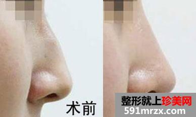 驼峰鼻矫正前后对比图，长沙驼峰鼻矫正多少钱？长沙正规整形医院排名推荐