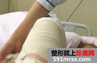 正规医院自体脂肪移植隆胸多少钱？隆胸前后对比图