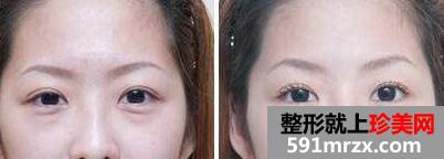 去眼袋手术前后对比图，昆明去眼袋手术多少钱