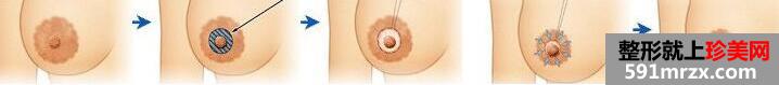 乳晕乳头缩小对比图，乳晕缩小原理图