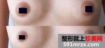 乳晕乳头缩小对比图，沈阳乳晕缩小手术多少钱？