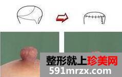 乳头乳晕缩小图