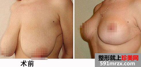 巨乳缩小手术多少钱？巨乳缩小对比图