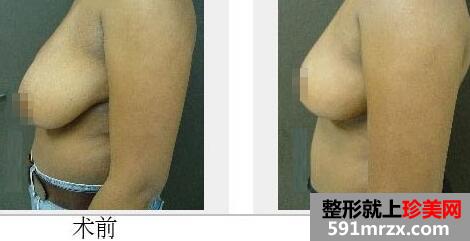 巨乳缩小手术多少钱？巨乳缩小对比图