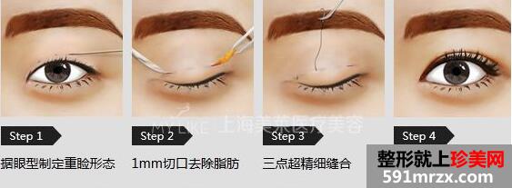 韩式三点双眼皮原理图