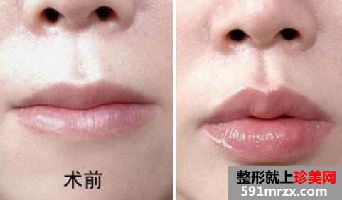 自体脂肪丰唇前后对比图，丰唇手术价格、方法