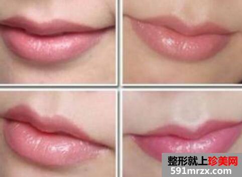 成都哪家整形医院做丰唇手术好？丰唇手术价格多少？