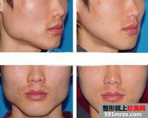 男士磨下颌角整形对比图