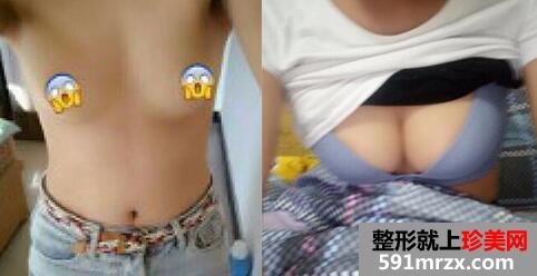胸部整形前后对比图，深圳阳光整形美容医院最新整形价格