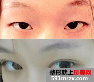 双眼皮整形前后对比图