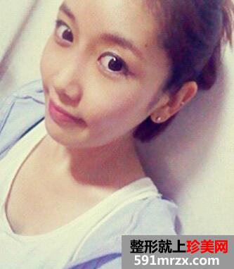 北京八大处下颌角+磨颧骨整形价格78000元和案例