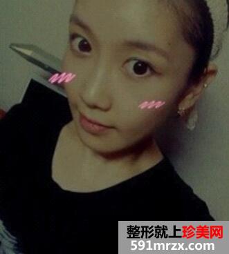 北京八大处下颌角+磨颧骨整形价格78000元和案例