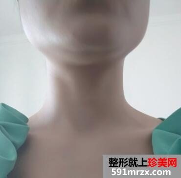 下颌角整形前后对比图案例分享，上海做下颌角磨骨整形价格