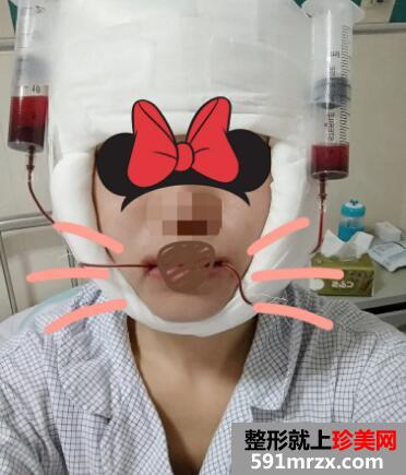 下颌角整形前后对比图案例分享，上海做下颌角磨骨整形价格