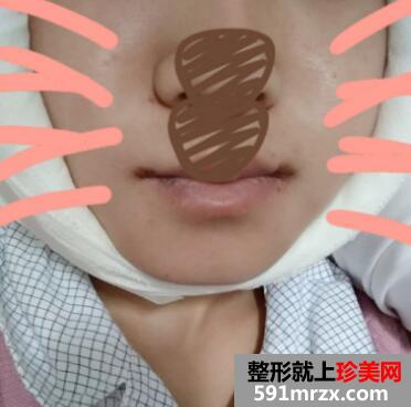 下颌角整形前后对比图案例分享，上海做下颌角磨骨整形价格