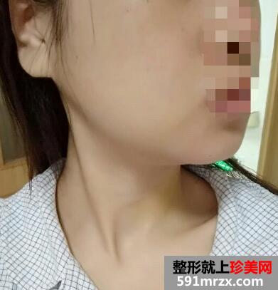 下颌角整形前后对比图案例分享，上海做下颌角磨骨整形价格
