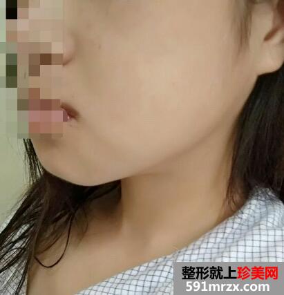 下颌角整形前后对比图案例分享，上海做下颌角磨骨整形价格
