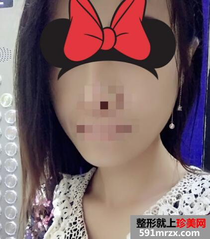 下颌角整形前后对比图案例分享，上海做下颌角磨骨整形价格