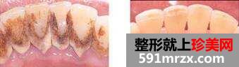 洗牙