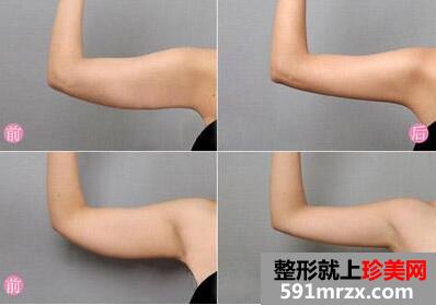 吸脂减肥前后对比图，抽脂减肥大概多少钱