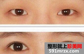 肿泡眼割双眼皮价格和恢复图