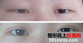 肿泡眼割双眼皮价格和恢复图