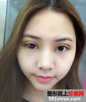 北京割双眼皮和开内眼角价格真实案例图片