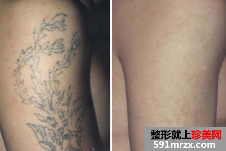 激光洗纹身多少钱?效果图