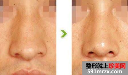 鹰钩鼻整形前后对比图