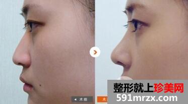 隆鼻手术及隆鼻价格表介绍