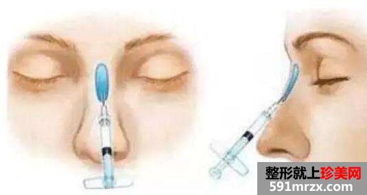 上海华美玻尿酸隆鼻价格和图片对比