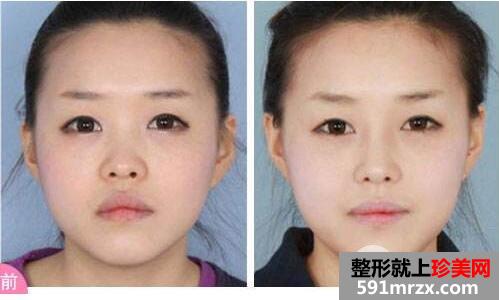 上海华美玻尿酸隆鼻价格和图片对比