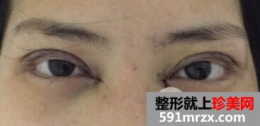 做了割双眼皮+开眼角两项的眼综合整形手术 效果图和恢复经历