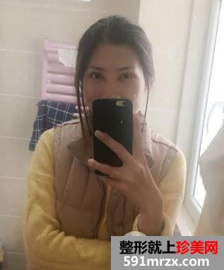 做了割双眼皮+开眼角两项的眼综合整形手术 效果图和恢复经历
