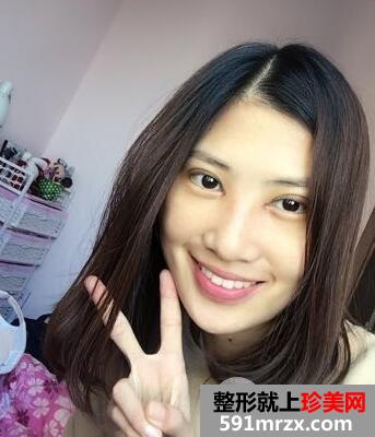 做了割双眼皮+开眼角两项的眼综合整形手术 效果图和恢复经历