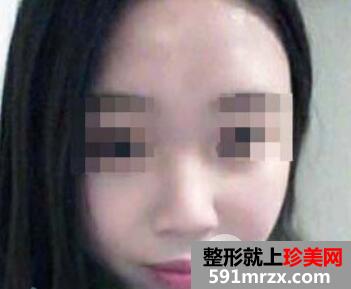 做了鼻综合整形价格2.3万,隆鼻效果图真实案例分享