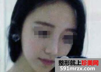 做了鼻综合整形价格2.3万,隆鼻效果图真实案例分享