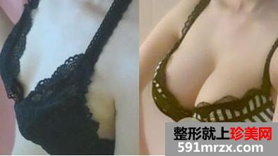 隆胸手术多少钱?假体隆胸后手感效果真实自然吗?