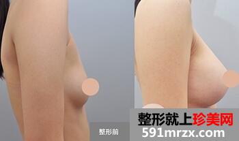 隆胸手术多少钱?假体隆胸后手感效果真实自然吗?