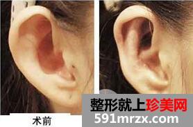招风耳矫正好不好?会不会留疤?