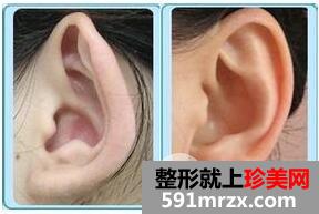 招风耳矫正好不好?会不会留疤?