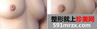 乳头内陷矫正术前后对比图  乳头内陷治疗价格介绍