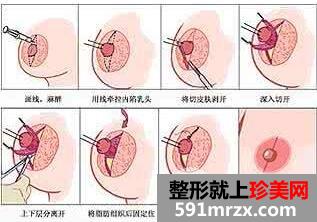 乳头内陷矫正术前后对比图  乳头内陷治疗价格介绍